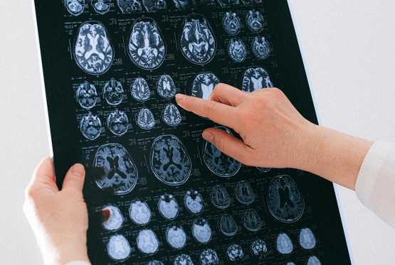 Veliki napredak u istraživanju: Naučnici mapiraju ljudski mozak