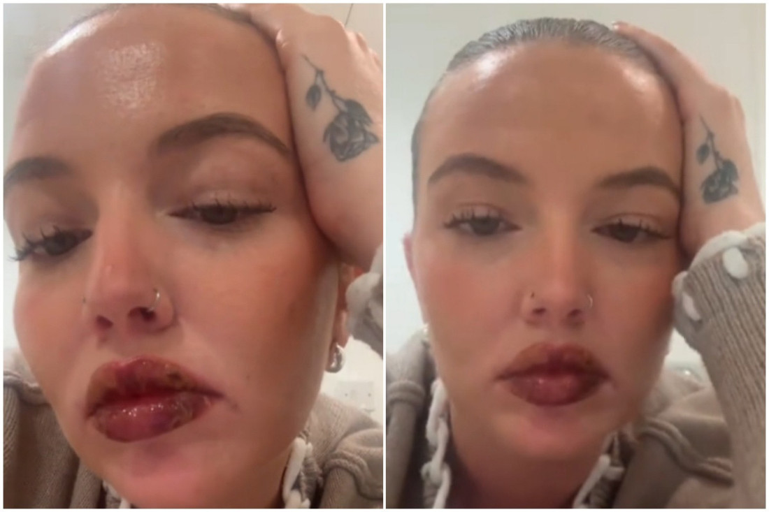 Devojka je dala je 460 evra za tretman usana i dobila herpes