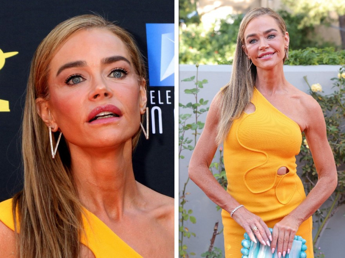 Deniz Ričards priznaje da je radila fejslifting